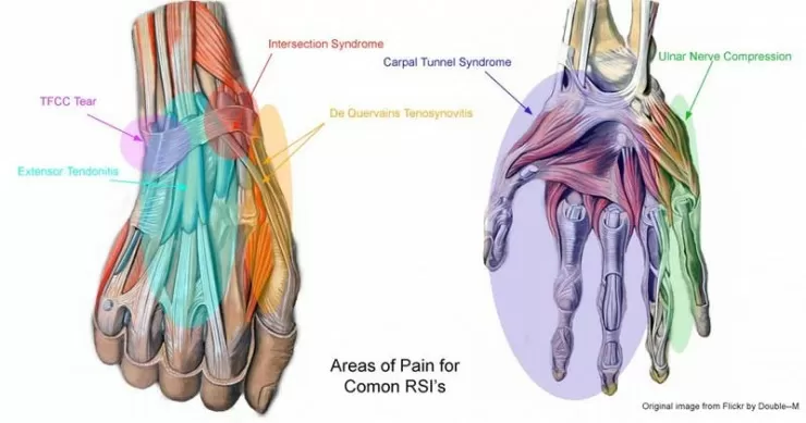Common RSI Area