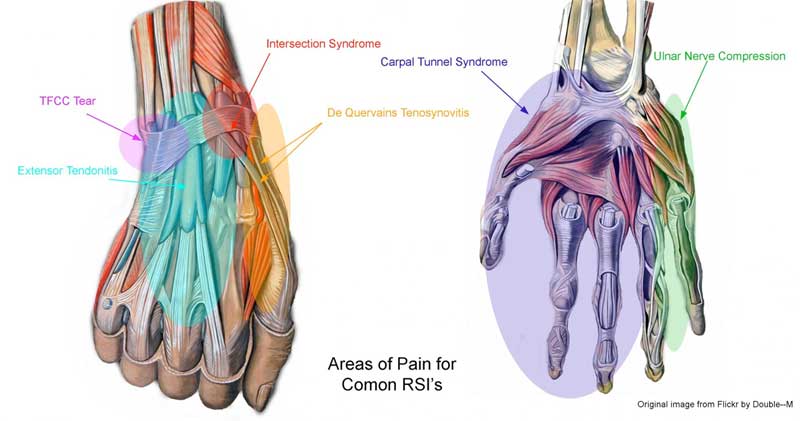 Wrist Relief: 6 Poses for RSI (Repetitive Stress Injury)